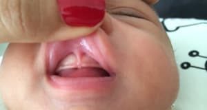 Dudak Bağı Nedir, Nasıl Anlaşılır, Nasıl Tedavi Edilir Tatlı Bir Telaş, Tatlı Bir Telaş, Tatlı Bir Telaş