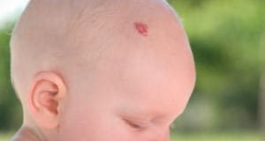 Bebeğim ve Hemanjiomu Tatlı Bir Telaş, Tatlı Bir Telaş, Tatlı Bir Telaş