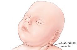 Tortikollis (Tortikolis) – Eğri Boyun Nedir Tatlı Bir Telaş, Tatlı Bir Telaş, Tatlı Bir Telaş