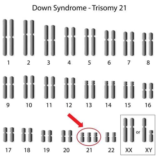 Trizomi, Trizomi ve Down Sendromu, Tatlı Bir Telaş